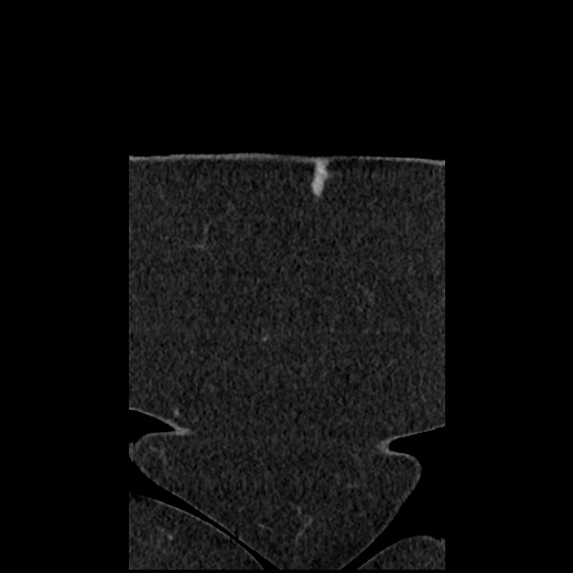 File:Acute cholecystitis and ureteric colic (Radiopaedia 42330-45444 Coronal prone 10).jpg