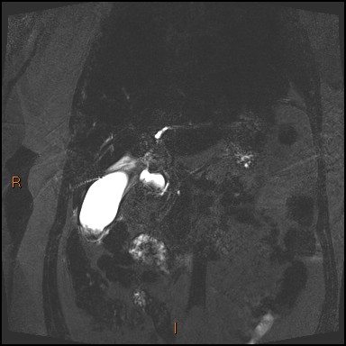 File:Acute cholecystitis with gallbladder neck calculus (Radiopaedia 42795-45971 Coronal Turbo spin echo 30).jpg