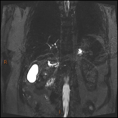 File:Acute cholecystitis with gallbladder neck calculus (Radiopaedia 42795-45971 Coronal Turbo spin echo 39).jpg