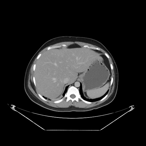 File:Acute complicated calculous cholecystitis (Radiopaedia 55202-61587 Axial C+ delayed 25).jpg