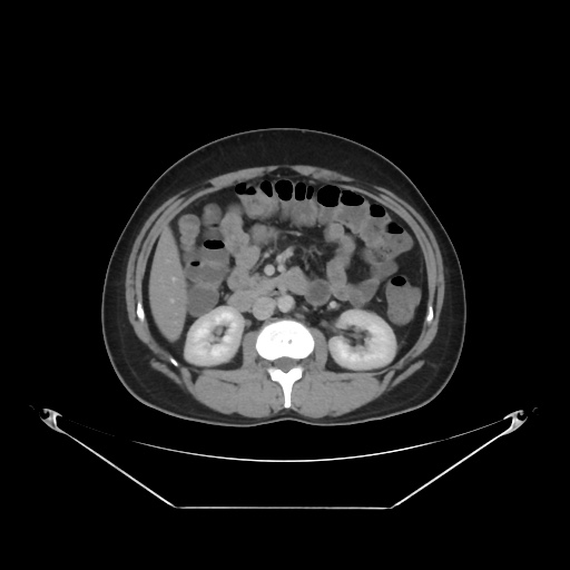 File:Acute complicated calculous cholecystitis (Radiopaedia 55202-61587 Axial C+ delayed 46).jpg