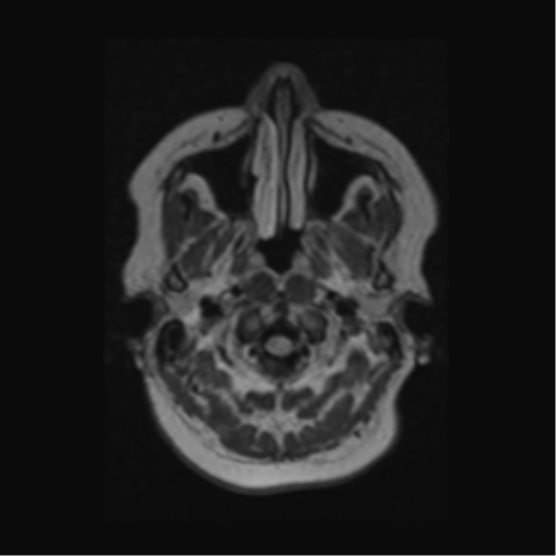 Acute disseminated encephalomyelitis (ADEM) (Radiopaedia 38073-40065 Axial FLAIR 1).png