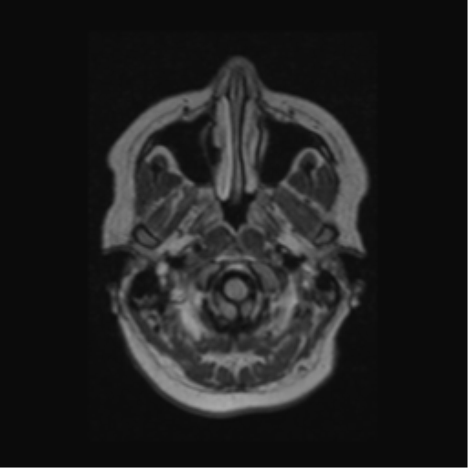 Acute disseminated encephalomyelitis (ADEM) (Radiopaedia 38073-40065 Axial FLAIR 3).png