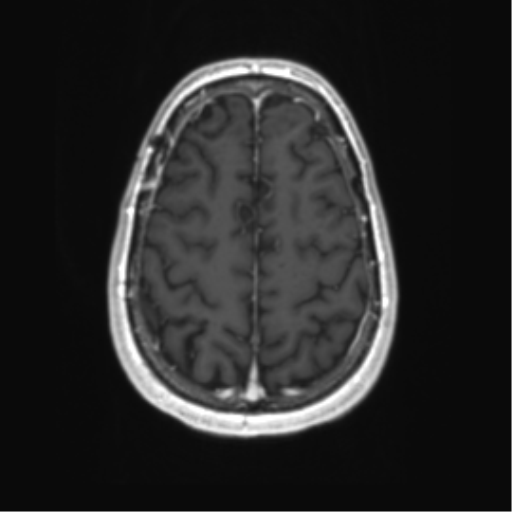 Acute disseminated encephalomyelitis (ADEM) (Radiopaedia 65319-74350 Axial T1 C+ 52).png