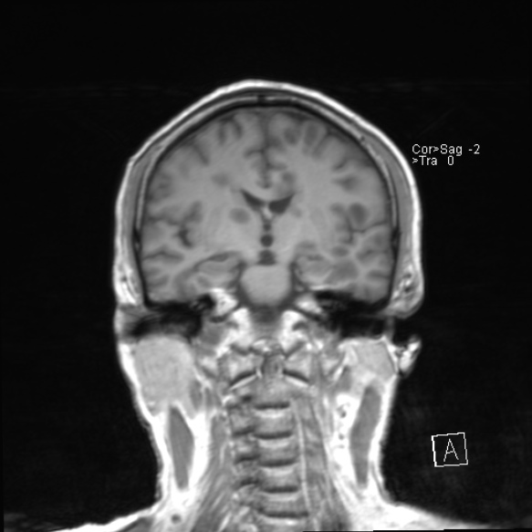 File:Acute disseminated encephalomyelitis (Radiopaedia 37253-39033 Coronal T1 14).jpg