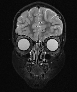 File:Acute disseminating encephalomyelitis with bilateral optic neuritis (Radiopaedia 79676-92886 Coronal STIR 4).jpg