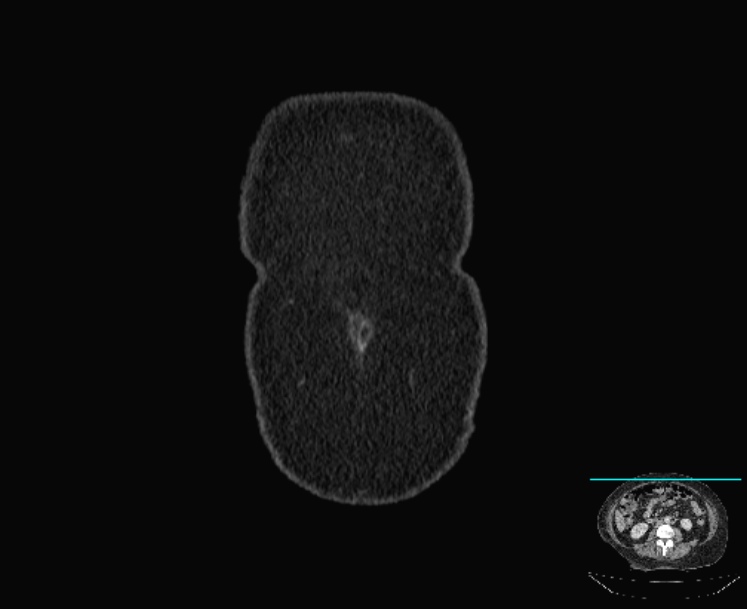 Acute diverticulitis (Radiopaedia 28066-28325 Coronal C+ portal venous phase 5).jpg