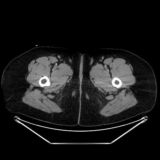 Acute diverticulitis - transverse colon (Radiopaedia 87063-103327 Axial C+ portal venous phase 192).jpg