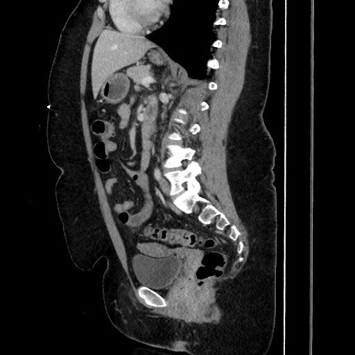 Acute diverticulitis - transverse colon (Radiopaedia 87063-103327 Sagittal C+ portal venous phase 132).jpg