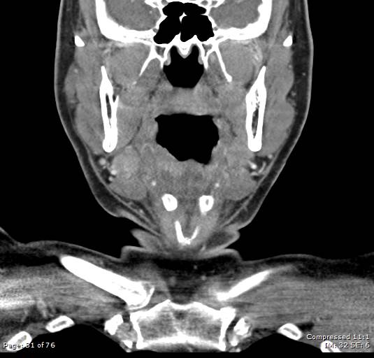 Acute epiglottitis (Radiopaedia 54375-60590 Coronal C+ arterial phase 31).jpg