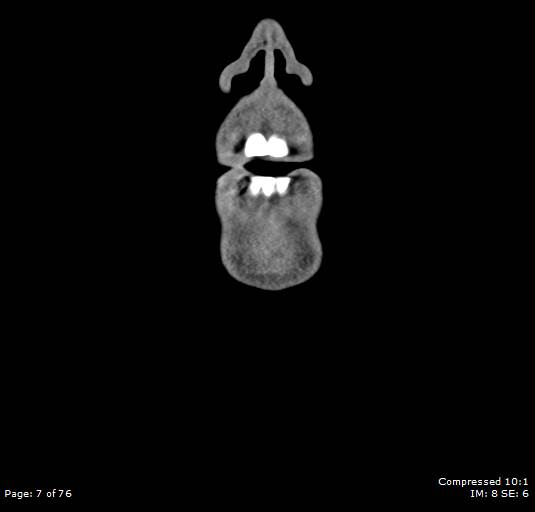 Acute epiglottitis (Radiopaedia 54375-60590 Coronal C+ arterial phase 7).jpg