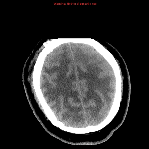 File:Acute hemorrhagic leukoencephalitis (Radiopaedia 14076-72275 Axial non-contrast 34).jpg