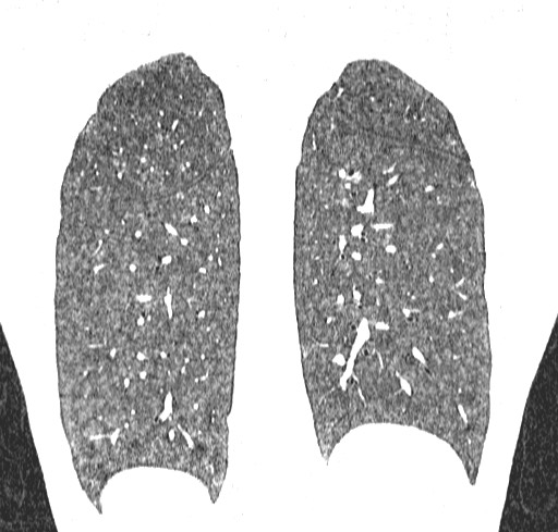 Acute hypersensitivity pneumonitis (Radiopaedia 85293-100870 Coronal lung window 105).jpg