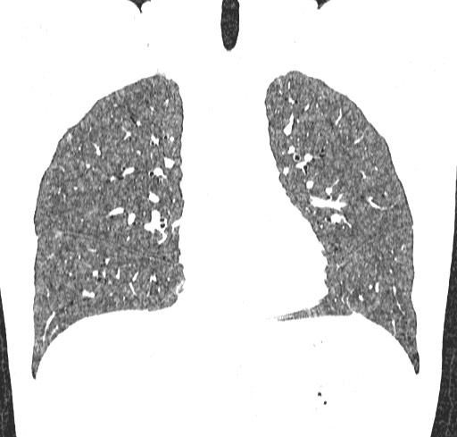 File:Acute hypersensitivity pneumonitis (Radiopaedia 85293-100870 Coronal lung window 52).jpg