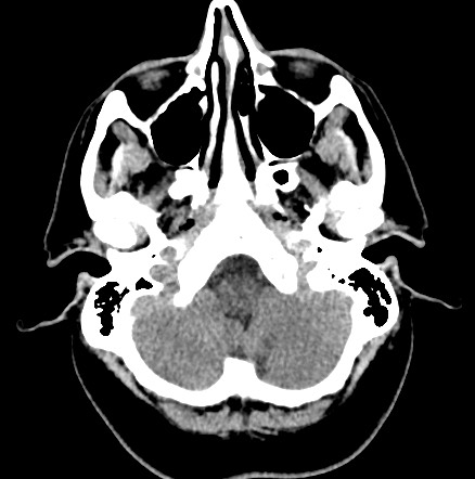 Acute internal carotid artery dissection (Radiopaedia 53541-59558 Axial non-contrast 9).jpg