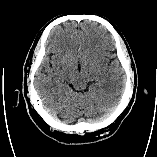 File:Acute left middle cerebral artery territory ischemic stroke (Radiopaedia 35688-37223 Axial non-contrast 32).png