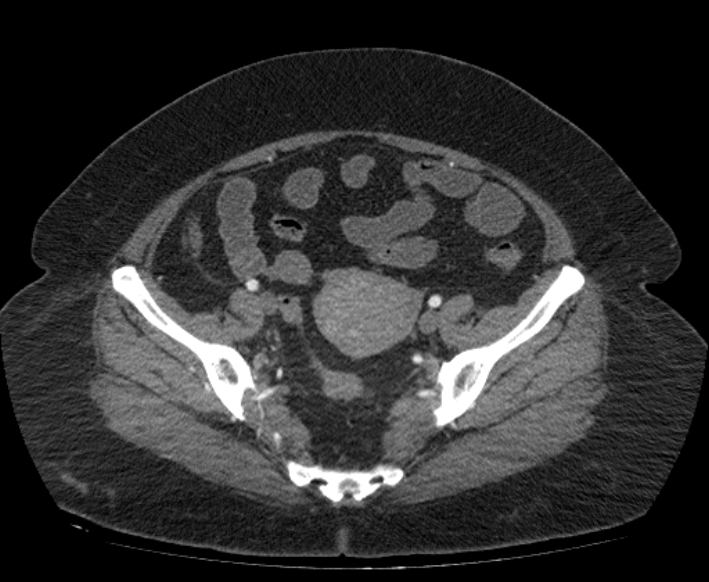Acute mesenteric ischemia (Radiopaedia 80029-93316 Axial C+ arterial phase 107).jpg