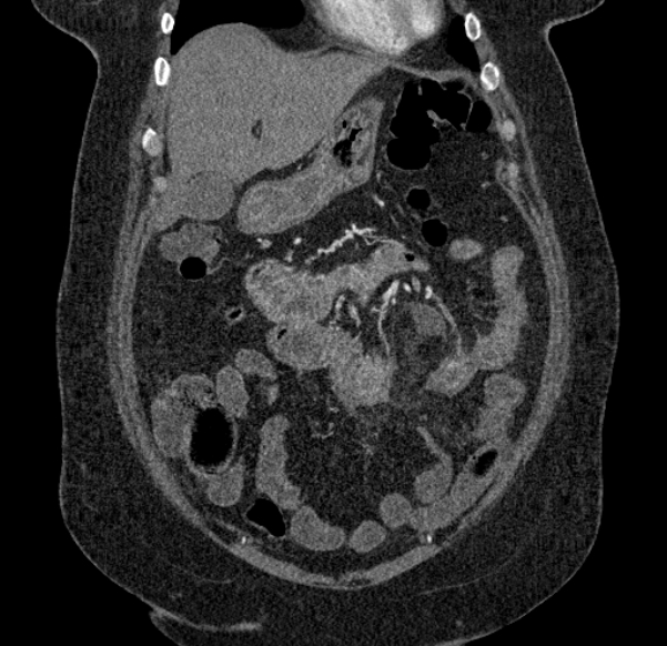 Acute mesenteric ischemia (Radiopaedia 80029-93316 Coronal C+ arterial phase 32).jpg