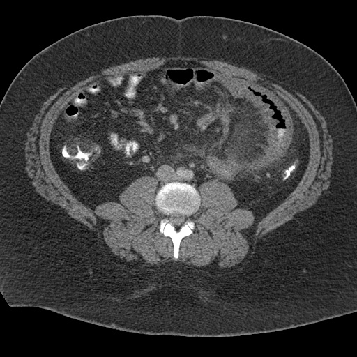 Acute mesenteric venous ischemia (Radiopaedia 46041-50383 Axial C+ portal venous phase 72).jpg