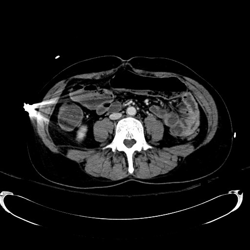 Acute myocardial infarction in CT (Radiopaedia 39947-42415 Axial C+ portal venous phase 74).jpg