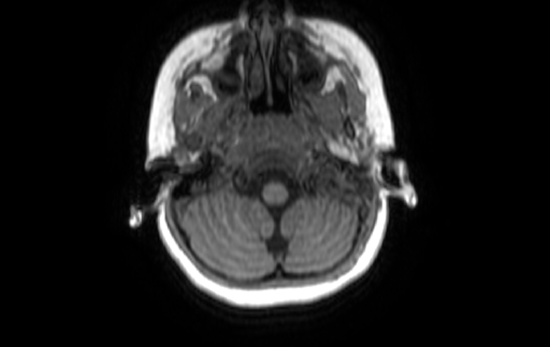 Acute necrotizing encephalitis of childhood (Radiopaedia 67356-76737 Axial T1 83).jpg