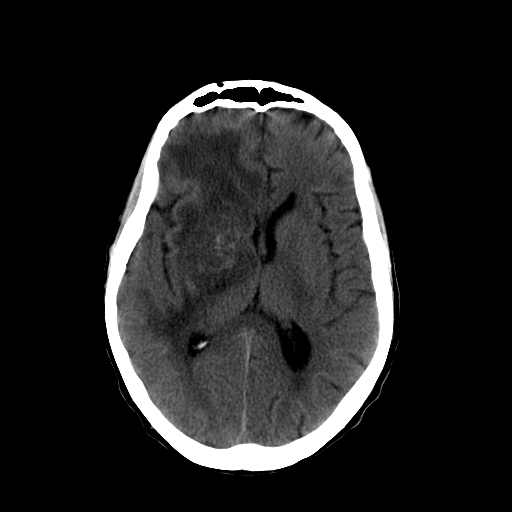 File:Acute necrotizing toxoplasma encephalitis (Radiopaedia 10683-11150 B 16).jpg
