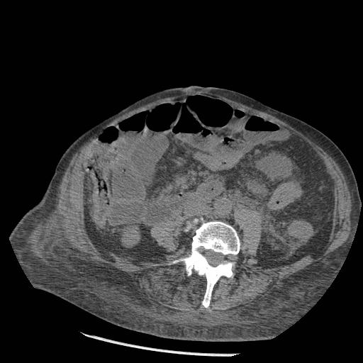 Acute on chronic pancreatitis (Radiopaedia 13233-13244 Axial non-contrast 64).jpg