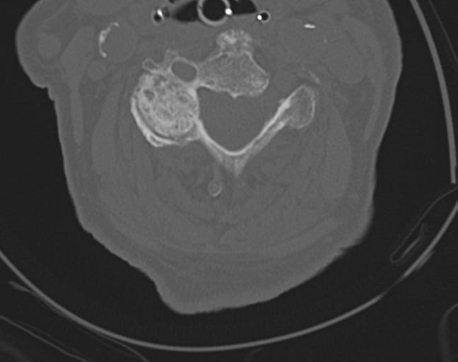 Acute on chronic subdural hematoma and thoracic vertebral injury in a multitrauma patient (Radiopaedia 31698-32619 Axial bone window 31).jpg