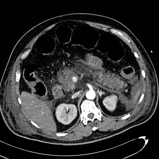 File:Acute pancreatic necrosis (Radiopaedia 13560-13486 Axial C+ portal venous phase 56).jpg