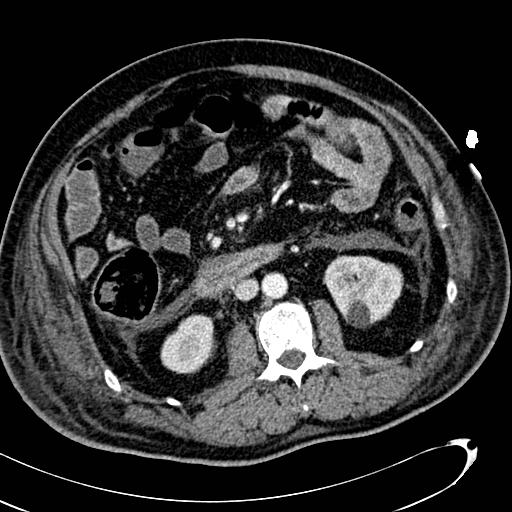 File:Acute pancreatic necrosis (Radiopaedia 13560-13486 Axial C+ portal venous phase 79).jpg
