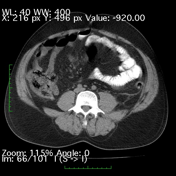 Acute pancreatitis (Radiopaedia 34043-35276 Axial non-contrast 66).jpg