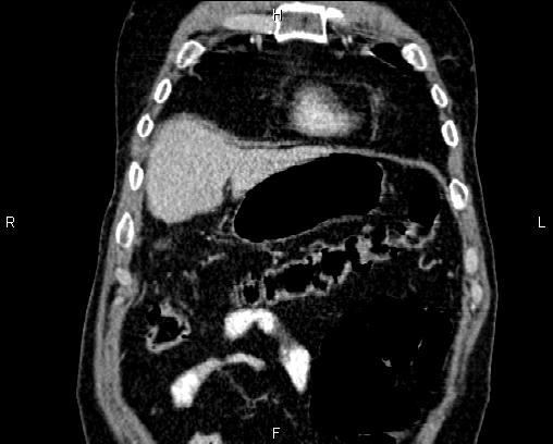Acute pancreatitis (Radiopaedia 85146-100701 Coronal C+ portal venous phase 10).jpg