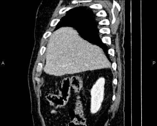 Acute pancreatitis (Radiopaedia 85146-100701 Sagittal C+ portal venous phase 14).jpg