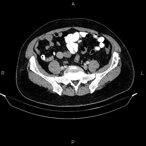 Acute pancreatitis (Radiopaedia 85390-101010 Axial C+ portal venous phase 80).jpg