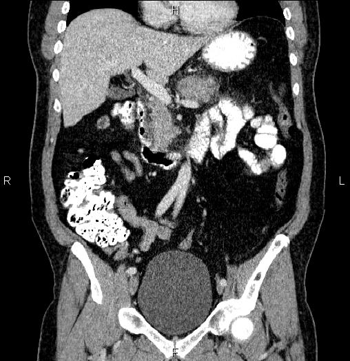 Acute pancreatitis (Radiopaedia 85390-101010 Coronal C+ portal venous phase 31).jpg