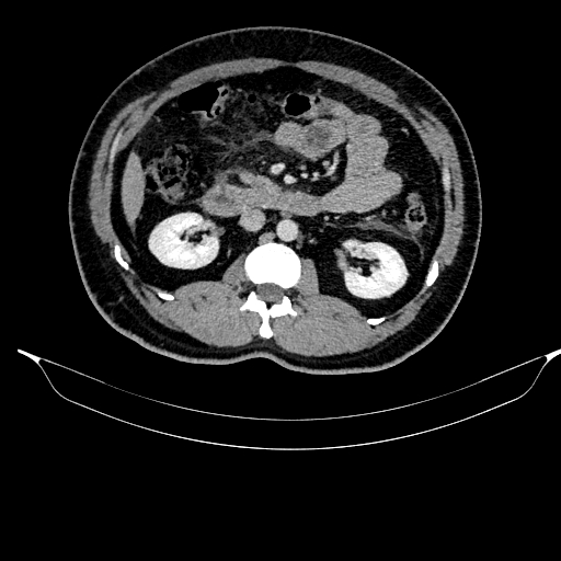 Acute pancreatitis (Radiopaedia 87428-103757 Axial C+ portal venous phase 45).jpg