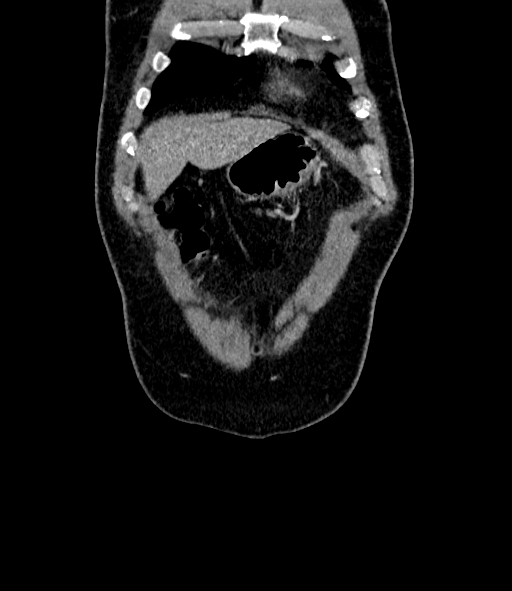 Acute pancreatitis (Radiopaedia 87428-103757 Coronal C+ portal venous phase 10).jpg