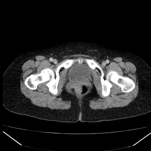 Acute pancreatitis - Balthazar C (Radiopaedia 26569-26714 Axial C+ portal venous phase 94).jpg