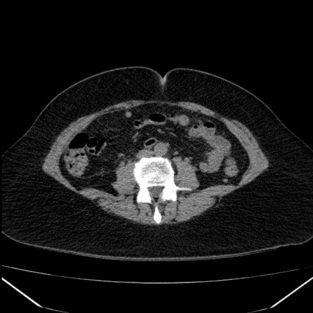Acute pancreatitis - Balthazar C (Radiopaedia 26569-26714 Axial non-contrast 56).jpg
