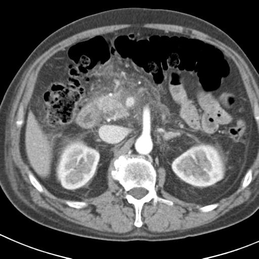 File:Acute pancreatitis and walled-off necrosis (Radiopaedia 29888-30403 Axial C+ portal venous phase 17).jpg