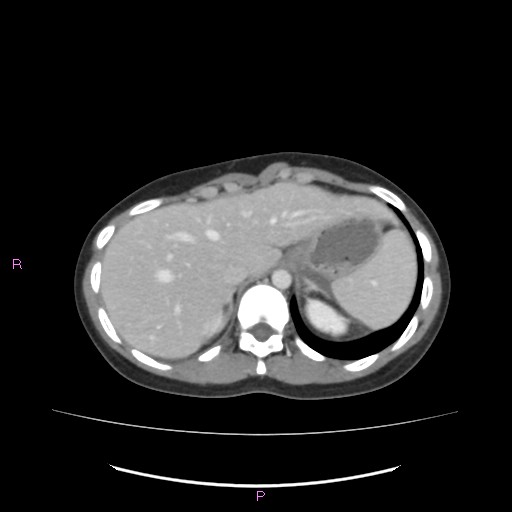 Acute pancreatitis secondary to stone at minor papilla and pancreatic divisum (Radiopaedia 76570-88333 Axial C+ portal venous phase 15).jpg