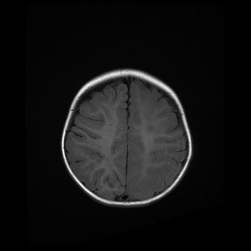 File:Acute phase of hemiconvulsion-hemiplegia epilepsy syndrome (Radiopaedia 29309-29745 Axial T1 7).jpg