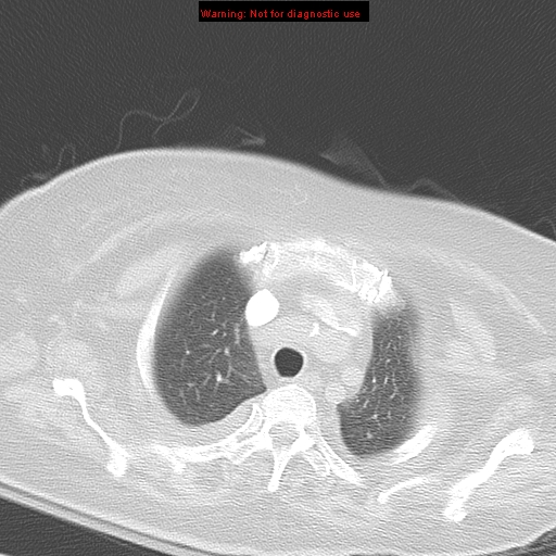 File:Acute pulmonary embolism (Radiopaedia 13286-13289 B 9).jpg