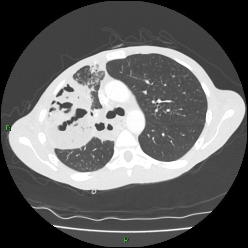 Acute right lung abscess (Radiopaedia 34806-36258 Axial lung window 65).jpg