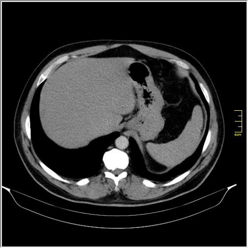 File:Acute right sided diverticulitis (Radiopaedia 65249-74268 Axial C+ portal venous phase 11).JPG