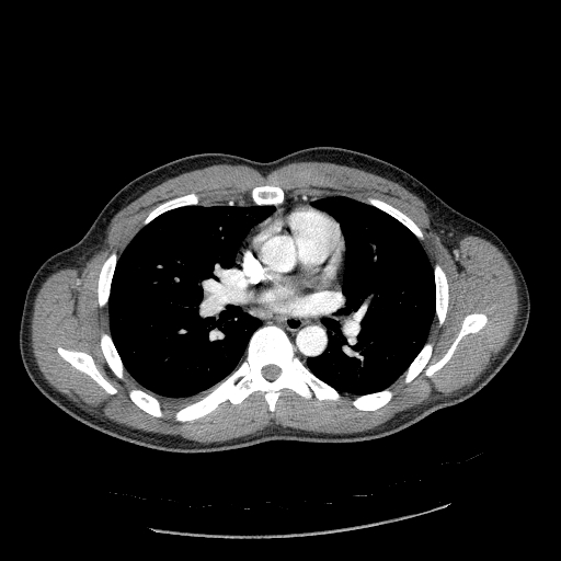 File:Acute segmental pulmonary emboli and pulmonary infarction (Radiopaedia 62264-70444 Axial C+ CTPA 56).jpg
