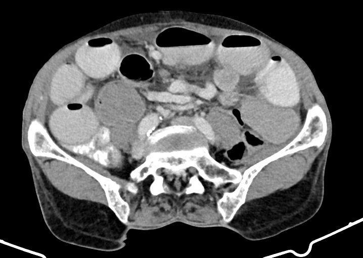 Acute small bowel (ileal) volvulus (Radiopaedia 71740-82139 Axial C+ portal venous phase 137).jpg