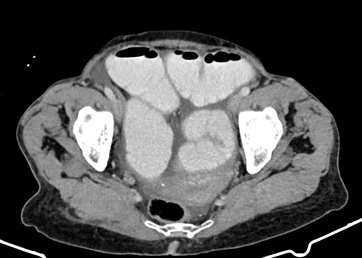 Acute small bowel (ileal) volvulus (Radiopaedia 71740-82139 Axial C+ portal venous phase 174).jpg
