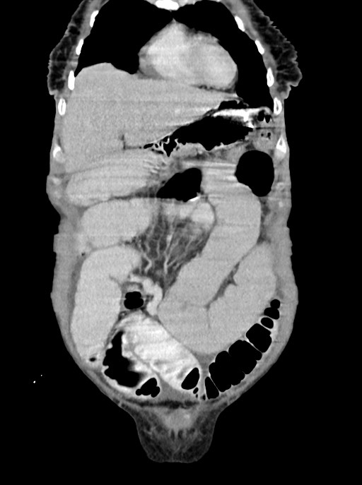 Acute small bowel (ileal) volvulus (Radiopaedia 71740-82139 Coronal C+ portal venous phase 26).jpg