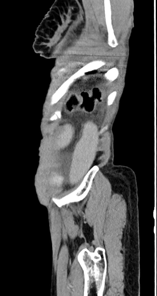 Acute small bowel (ileal) volvulus (Radiopaedia 71740-82139 Sagittal C+ portal venous phase 29).jpg